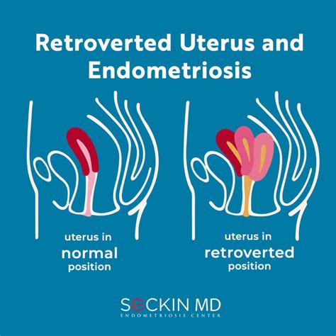 retroverted or tilted uterus and endometriosis
