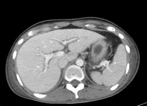 Contrast Enhanced Computed Tomography Scan Showing Axial Section Of The