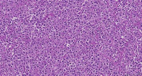 H And E Slide 200× Diffusely Infiltrative Diffuse Large B Cell Lymphoma