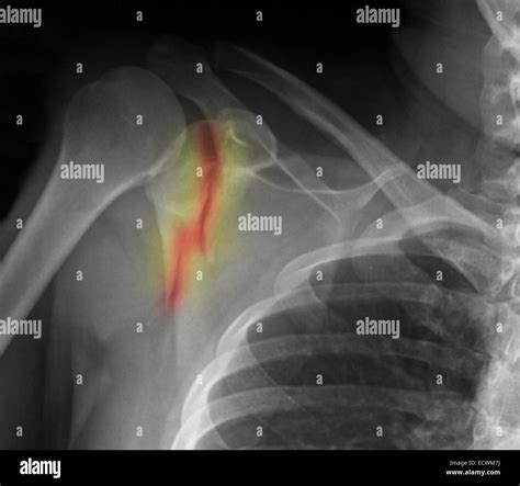 Shoulder X Ray Showing Fractured Scapula Stock Photo Alamy