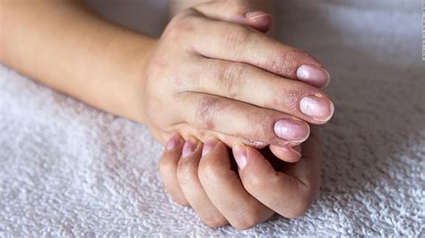People With Eczema At Higher Risk Of Suicidal Thoughts And Attempts