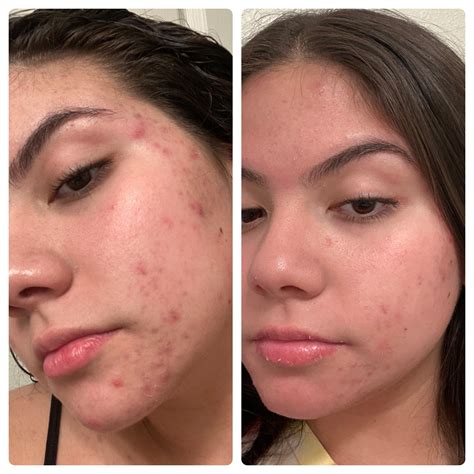 Skin Purging Before And After