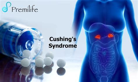 Cushings Syndrome Premilife Homeopathic Remedies