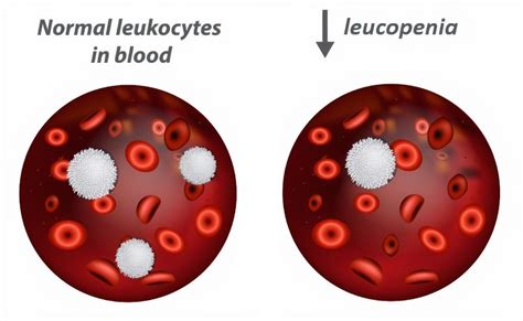 Understanding White Blood Cell Count Normal High And Low