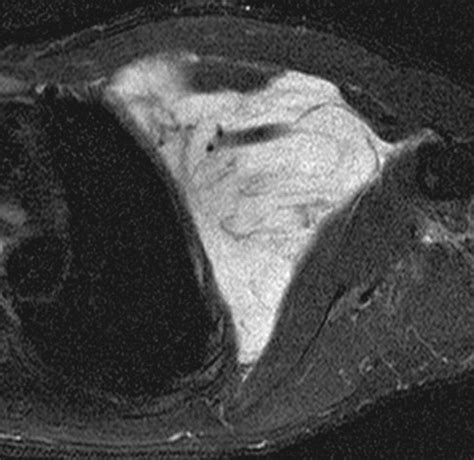Imaging Of Primary Chest Wall Tumors With Radiologic Pathologic