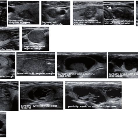 Sonographic Characteristics Of Thyroid Nodules Adapted From Ata