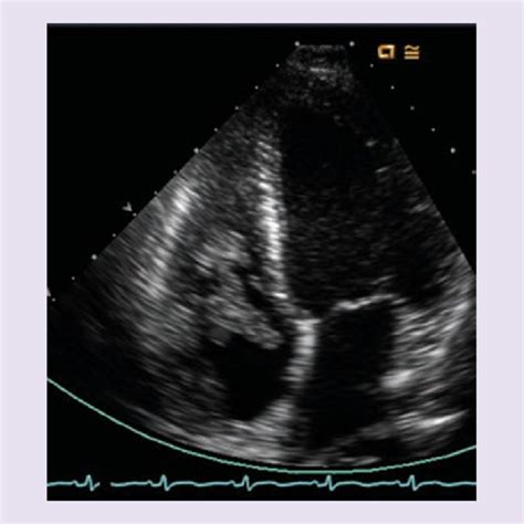 Echocardiogram Apical Four Chamber View Showing Large Tricuspid Valve