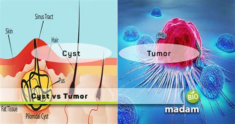 Difference Between Cyst And Tumor Biomadam