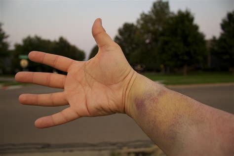 Physical Therapy Advice Bruising Wisconsin Public Radio