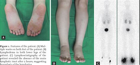 Figure 1 From First Korean Case Of Emberger Syndrome Primary