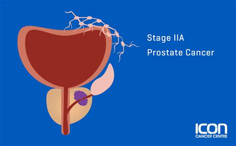 What Is Prostate Cancer Prostate Cancer Explained Icon Cancer Centre