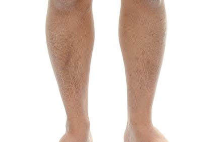 J'ai des tâches brunes sur les bras suite à petits boutons grattés et regrattés sur plusieurs mois. Qui d'autre a une Peau de Croco sur les jambes? Ma ...
