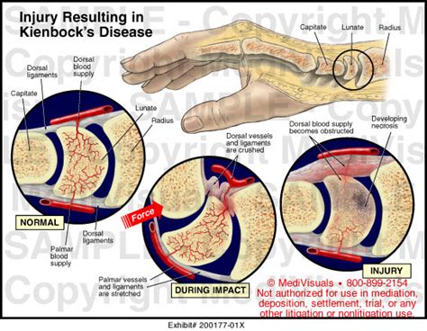 Injury Resulting In Kienbocks Disease Medical Illustration Medivisuals