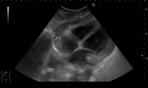 Tuberculous Pericarditis Echocardiography And Ultrasound Wikidoc