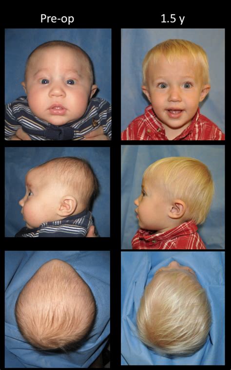 Before And After Craniosynostosis