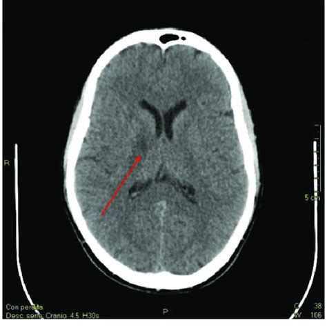 Brain Ct Scan Showing A Slight Hypodense Area In The Right Internal