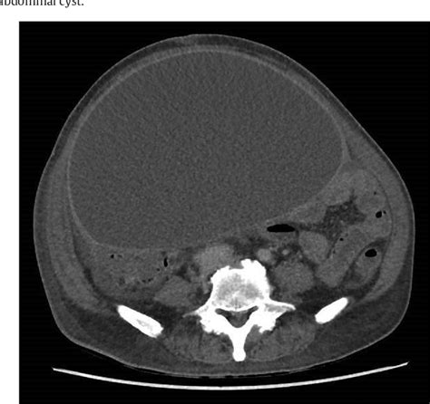 Figure 3 From A Case Report For A Diagnostic Dilemma Of A Giant Intra