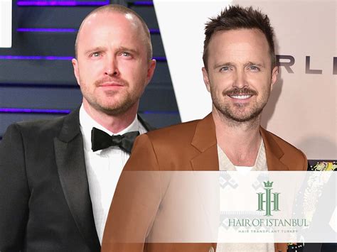Aaron Paul Hair Transplant Is The New Hairline For Real