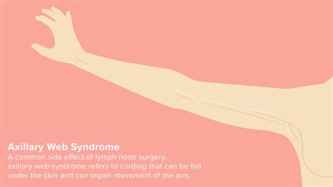 Axillary web sindrom vezivanje nakon operacije dojke Zdravlje vašeg