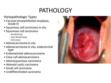 Pin On Squamous Cell Carcinoma Of Cervix