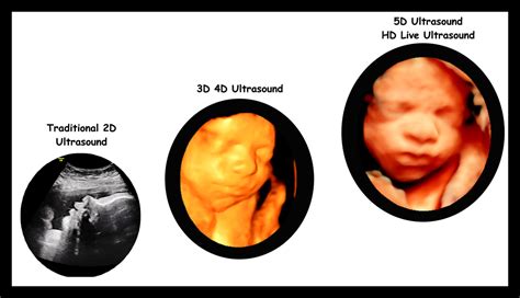 What Is 3d Vs 4d Ultrasound At Natasha Rodriguez Blog