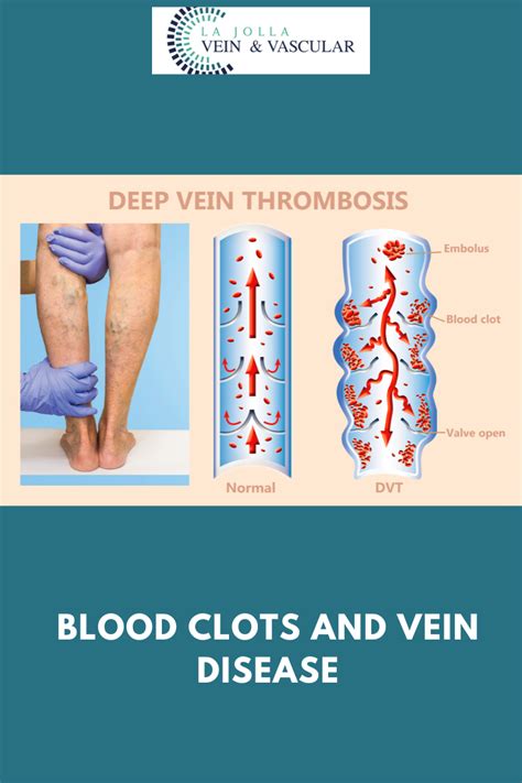 Vein And Vascular Treatment Vein And Vascular Care Clinic La Jolla Ca