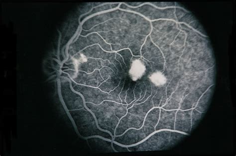 Presumed Ocular Histoplasmosis Syndrome With Choroidal Neovascular