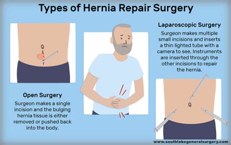 Pin On Hernia Problems Treatment And Surgery