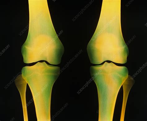Coloured X Ray Of Healthy Knee Joints Both Legs Stock Image P116