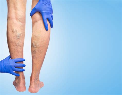 Leg Swelling Leaky Vein Valves Or Something Else The Vein Center Of