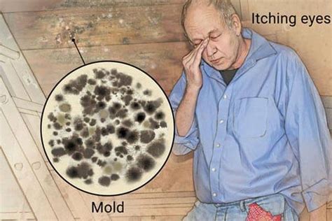 You'd know that you have a mold allergy and that you'd have to locate the mold to alleviate these symptoms if you notice the following things Mold Allergy Symptoms l Signs & Treatments l PRS