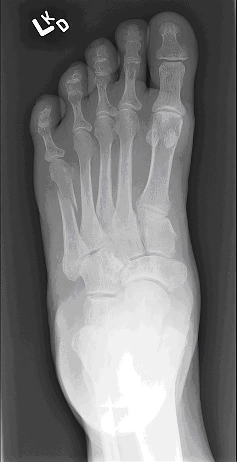 Fig 1 Oblique Distal Shaft Fracture Of The 5th Metatarsal