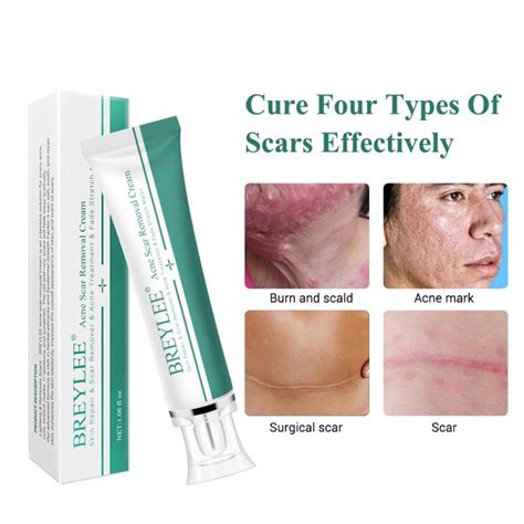 Acne Scar Removal Cream 30g Face Cream Skin Repair Skin Care Scar Acne