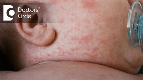 Baby Heat Rash Types Causes Prevention Treatment And