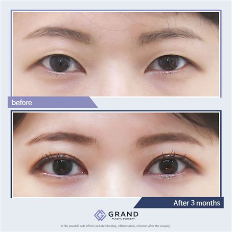 Natural looking double eyelid surgery, Natural adhesion method For free ...