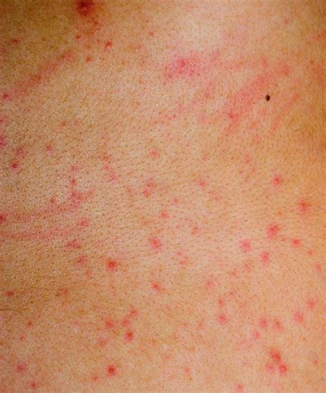 What Is The Connection Between Itchy Skin And Cancer