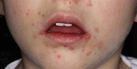 Acute Primary Herpetic Gingivostomatitis A Case Report Dentistryiq