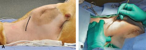 Lymphadenectomy Overview Of Surgical Anatomy And Removal Of Lymph Nodes