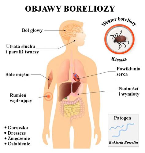 Borelioza Objawy Sprawd Jakie S Objawy Boreliozy