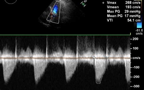 Aortic Stenosis Echocardiogram All About Cardiovascular System And