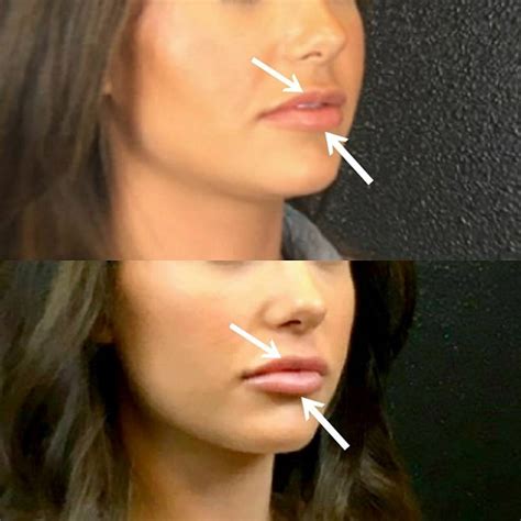 We did not find results for: $100 Off Any Lip Filler Of Your Choice - Mystique Medical ...