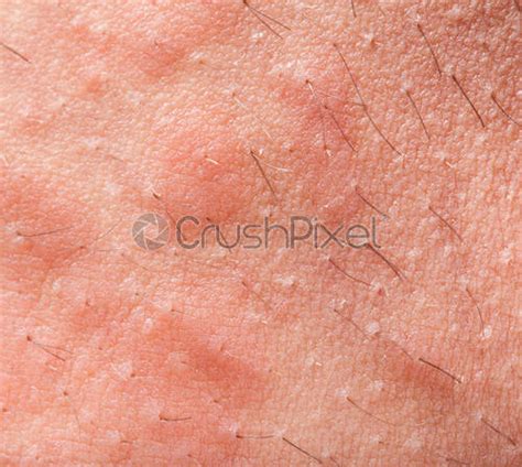 Eczema Groin Stock Photo Crushpixel