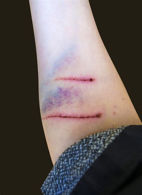 From The Dog Bite Is Wound Stock Photo Image Of Body 77340748