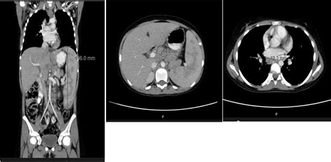 Prolonged Fever Pancytopenia And Splenomegaly Is It Sarcoidosis