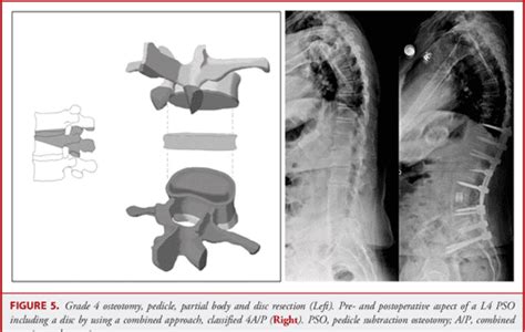 Pdf The Comprehensive Anatomical Spinal Osteotomy Classification