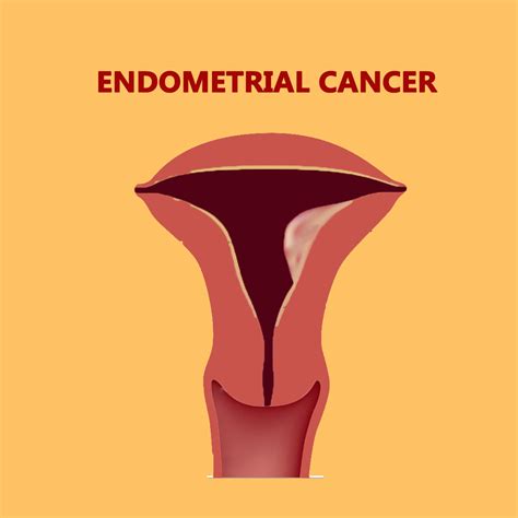 Best Cancer Hospital In India Endometrial Cancer Treatment In