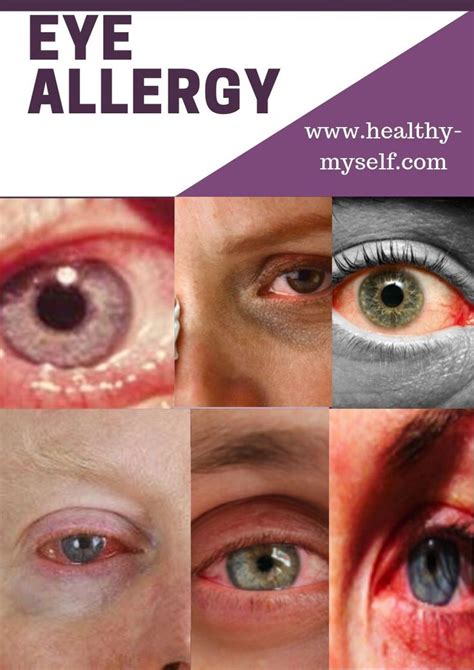 Eye Allergyeye Allergy Symptoms And Home Remidies Details 2019 Eye