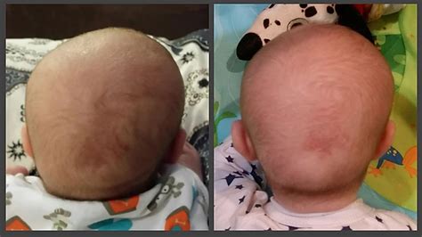 4 Key Points Every New Parent Should Know About Flat Head Syndrome