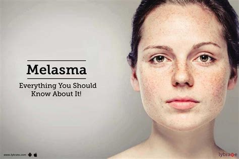 Melasma Everything You Should Know About It By Dr Priyanka Ghatge