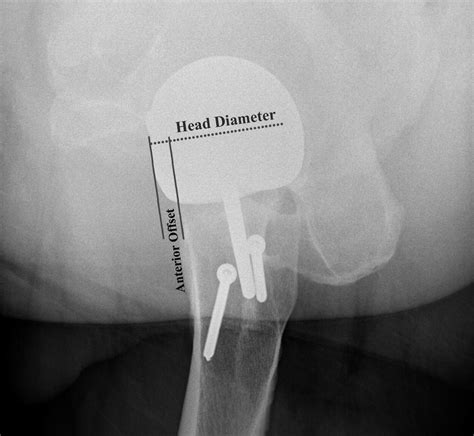 The Femoral Headneck Offset And Hip Resurfacing Bone And Joint